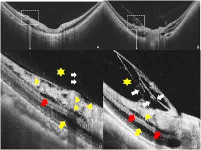 Hypodense regions in the peripapillary region increased the risk of macular retinoschisis detected by optical coherence tomography